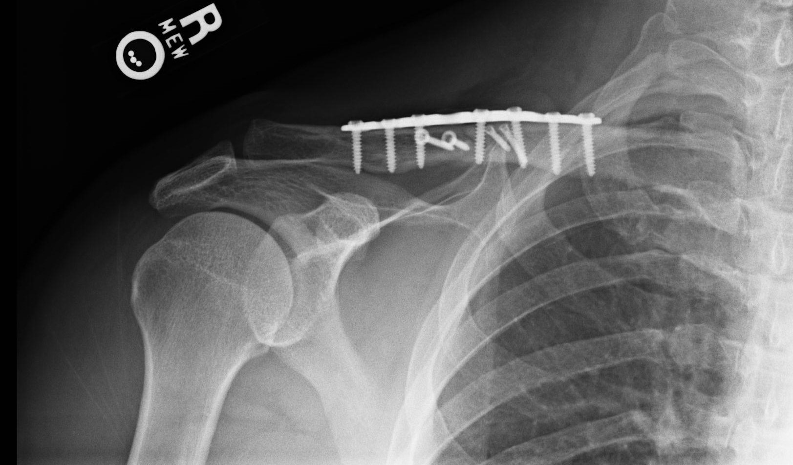 broken collarbone x ray